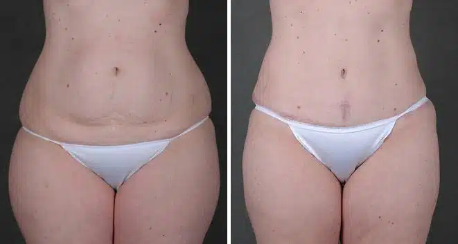 Liposuction Before and After Photos in Omaha, NE, Case 3826