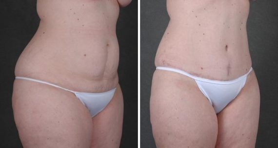 Liposuction Before and After Photos in Omaha, NE, Case 3826