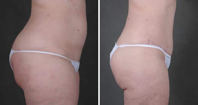 Liposuction Before and After Photos in Omaha, NE, Case 3826