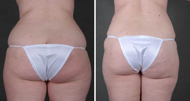 Liposuction Before and After Photos in Omaha, NE, Case 3826