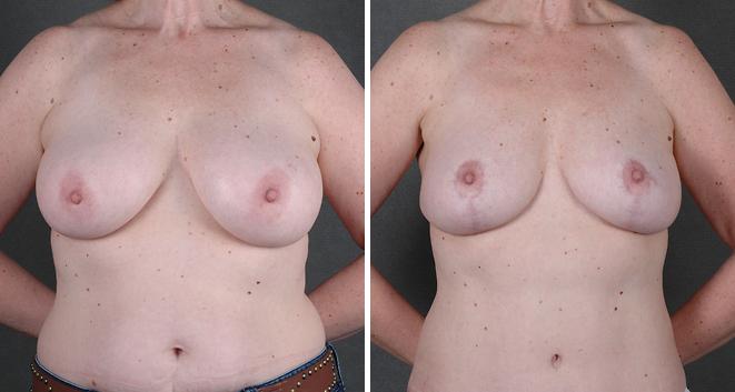 Liposuction Before and After Photos in Omaha, NE, Case 3826