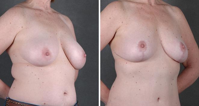 Liposuction Before and After Photos in Omaha, NE, Case 3826