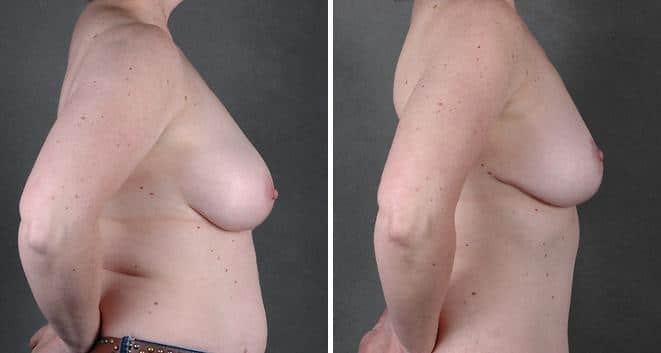 Liposuction Before and After Photos in Omaha, NE, Case 3826