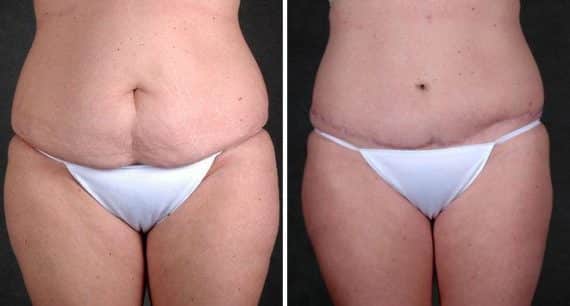 Liposuction Before and After Photos in Omaha, NE, Case 3848