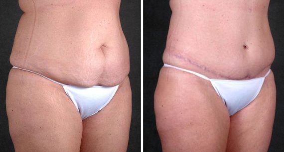 Liposuction Before and After Photos in Omaha, NE, Case 3848