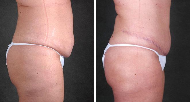 Liposuction Before and After Photos in Omaha, NE, Case 3848