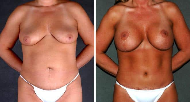 Liposuction Before and After Photos in Omaha, NE, Case 3899