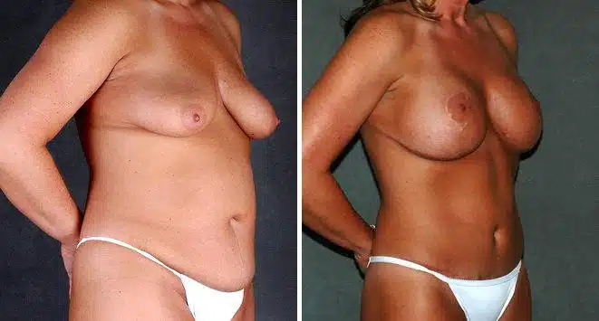 Liposuction Before and After Photos in Omaha, NE, Case 3899