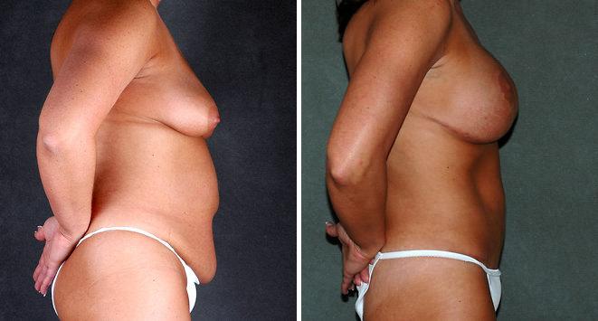 Liposuction Before and After Photos in Omaha, NE, Case 3899