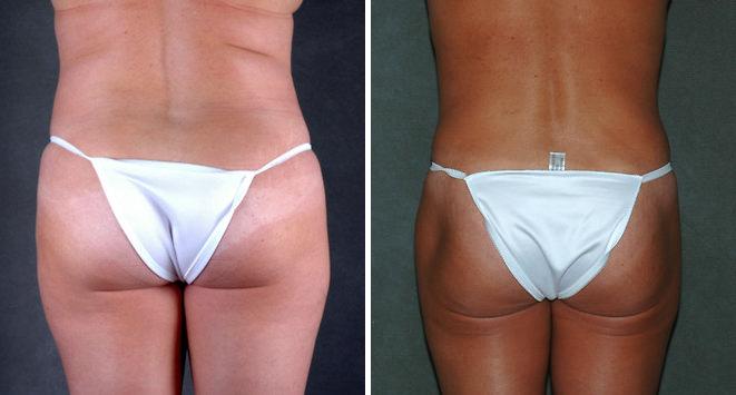 Liposuction Before and After Photos in Omaha, NE, Case 3899