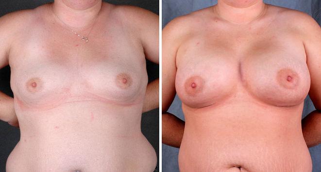 Liposuction Before and After Photos in Omaha, NE, Case 3917