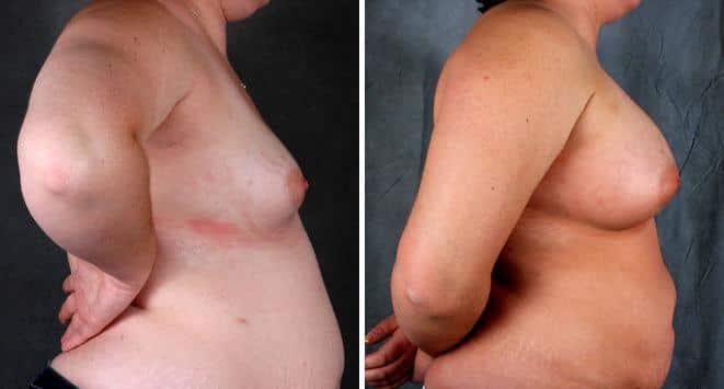 Liposuction Before and After Photos in Omaha, NE, Case 3917