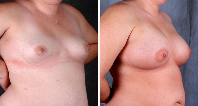 Liposuction Before and After Photos in Omaha, NE, Case 3917