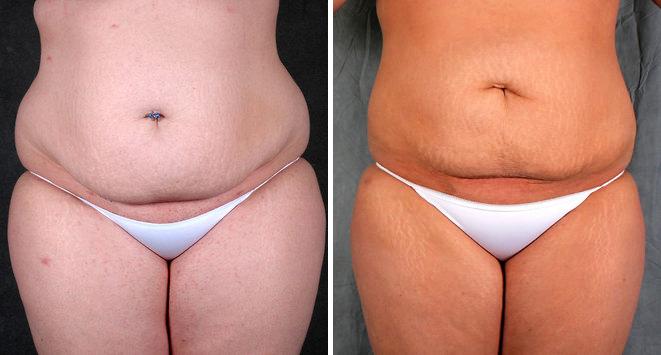 Liposuction Before and After Photos in Omaha, NE, Case 3917