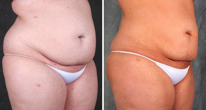 Liposuction Before and After Photos in Omaha, NE, Case 3917