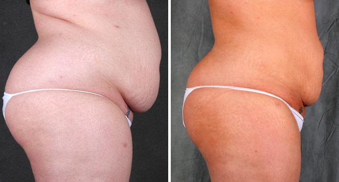 Liposuction Before and After Photos in Omaha, NE, Case 3917