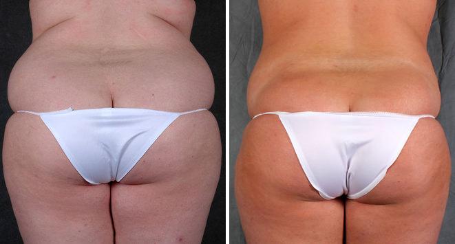 Liposuction Before and After Photos in Omaha, NE, Case 3917