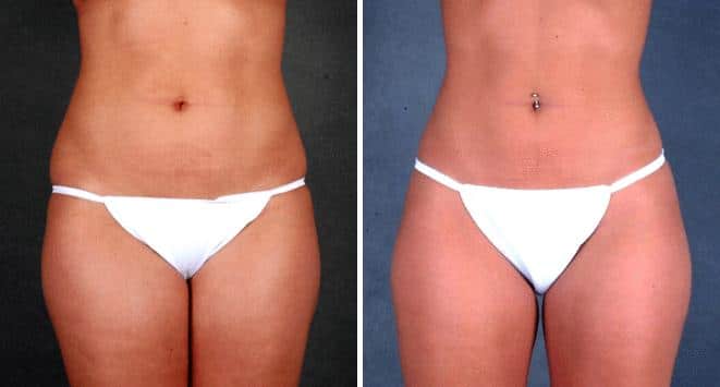 Liposuction Before and After Photos in Omaha, NE, Case 3940