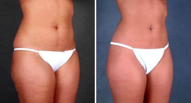 Liposuction Before and After Photos in Omaha, NE, Case 3940