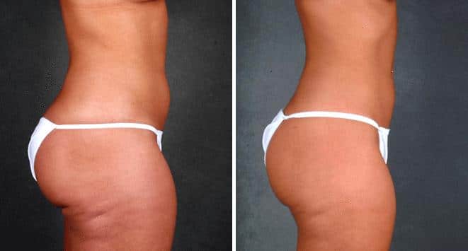 Liposuction Before and After Photos in Omaha, NE, Case 3940