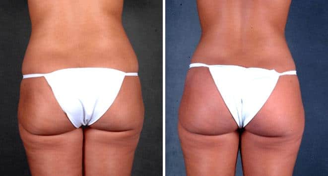 Liposuction Before and After Photos in Omaha, NE, Case 3940