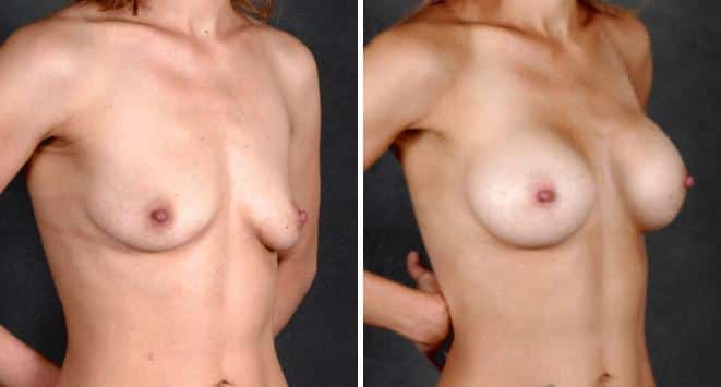 Liposuction Before and After Photos in Omaha, NE, Case 3962