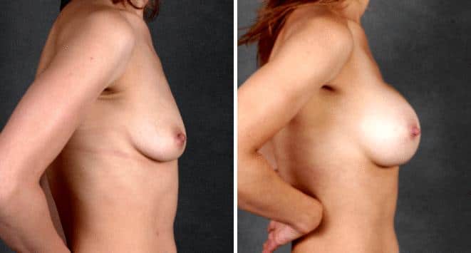 Liposuction Before and After Photos in Omaha, NE, Case 3962