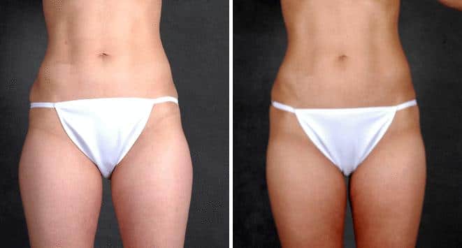 Liposuction Before and After Photos in Omaha, NE, Case 3962