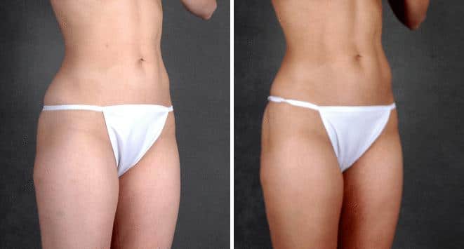 Liposuction Before and After Photos in Omaha, NE, Case 3962