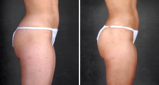 Liposuction Before and After Photos in Omaha, NE, Case 3962