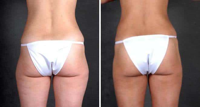 Liposuction Before and After Photos in Omaha, NE, Case 3962