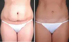 Liposuction Before and After Photos in Omaha, NE, Case 3998