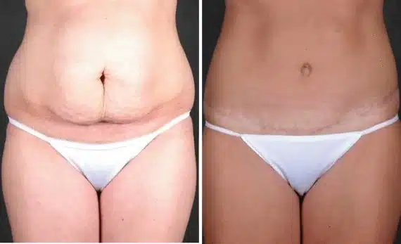 Liposuction Before and After Photos in Omaha, NE, Case 3998