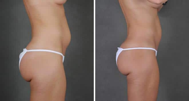 Liposuction Before and After Photos in Omaha, NE, Case 3770