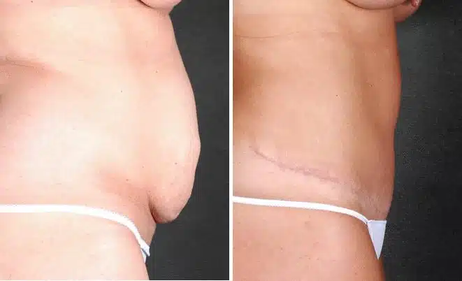 Liposuction Before and After Photos in Omaha, NE, Case 3998