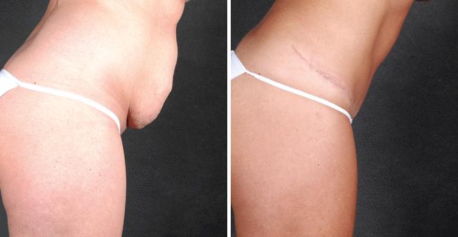 Liposuction Before and After Photos in Omaha, NE, Case 3998