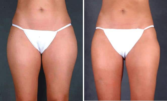 Liposuction Before and After Photos in Omaha, NE, Case 3801