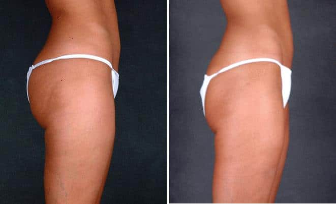 Liposuction Before and After Photos in Omaha, NE, Case 3801