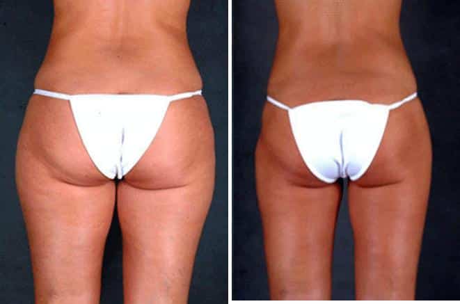 Liposuction Before and After Photos in Omaha, NE, Case 3801