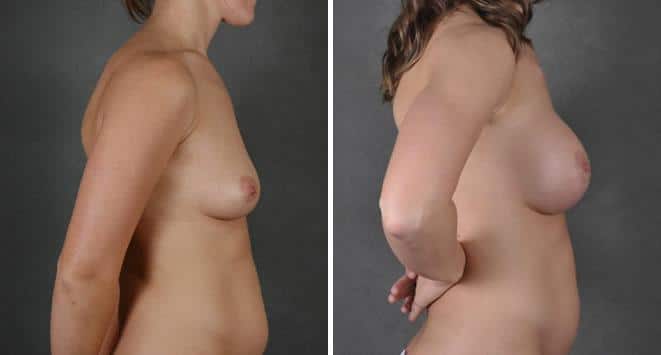 Liposuction Before and After Photos in Omaha, NE, Case 3770