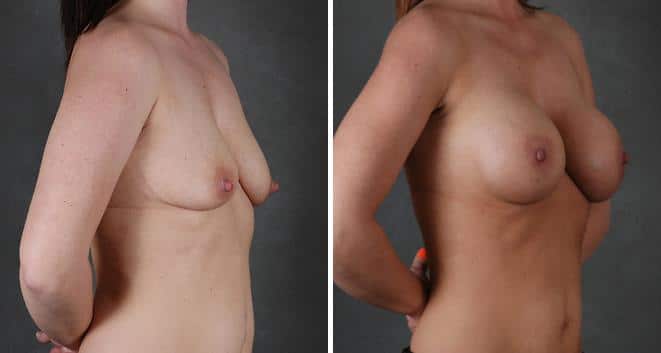 Breast Augmentation Before and After Photos in Omaha, NE, Case 3910