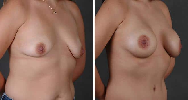 Breast Augmentation Before and After Photos in Omaha, NE, Case 3926