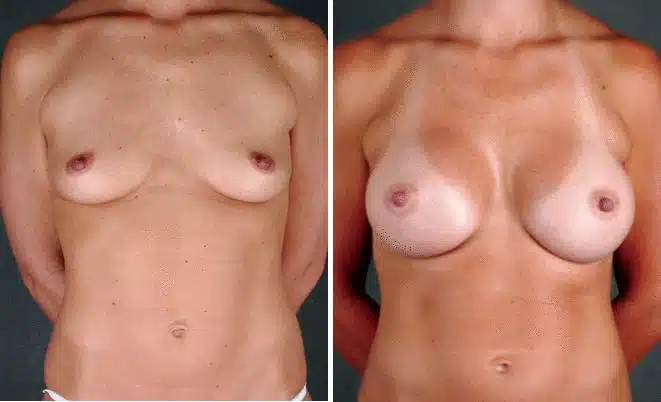 Breast Augmentation Before and After Photos in Omaha, NE, Case 3939