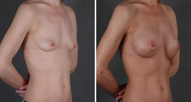 Breast Augmentation Before and After Photos in Omaha, NE, Case 3866