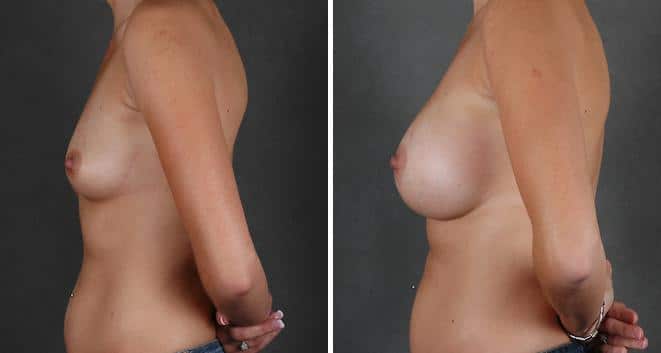 Breast Augmentation Before and After Photos in Omaha, NE, Case 3961