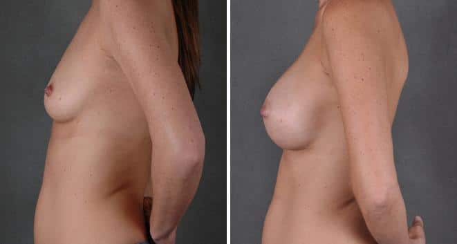 Breast Augmentation Before and After Photos in Omaha, NE, Case 3978