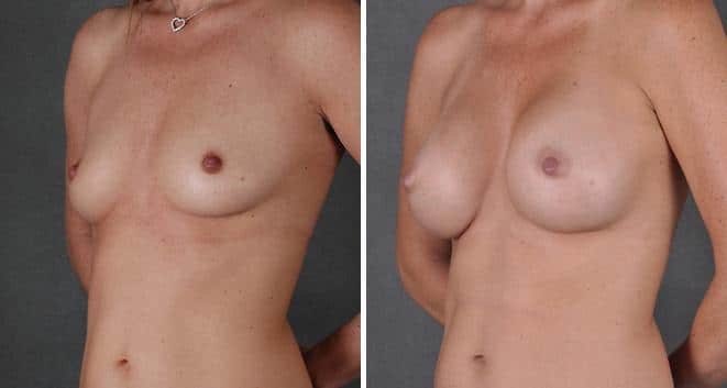 Breast Augmentation Before and After Photos in Omaha, NE, Case 3978