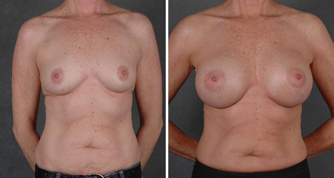 Breast Augmentation Before and After Photos in Omaha, NE, Case 3997