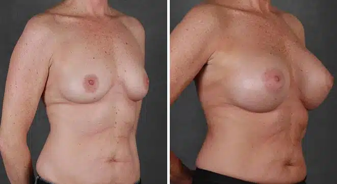 Breast Augmentation Before and After Photos in Omaha, NE, Case 3997