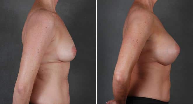 Breast Augmentation Before and After Photos in Omaha, NE, Case 3997